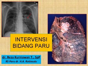 INTERVENSI BIDANG PARU dr Reza Kurniawan T Sp