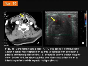 figs 20 A Figs 20 Carcinoma supragltico A