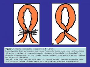 A B Figura 1 A Obstruccin intestinal en