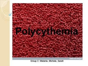 Polycythemia Group C Melanie Michele Sarah Polycythemia is