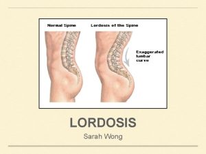 LORDOSIS Sarah Wong What is Lordosis LORDOSIS IS