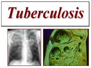 Tuberculosis enfermedad producida por alguno de los miembros