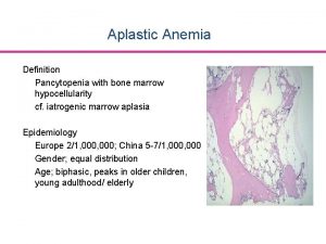 Aplastic Anemia Definition Pancytopenia with bone marrow hypocellularity