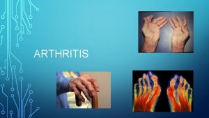 ARTHRITIS ABOUT ARTHRITIS Arthritis is inflammation of one
