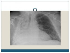 Atelectasis Introduction Atelectasis is the collapse of alveoli