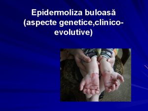 Epidermoliza buloas aspecte genetice clinicoevolutive Generaliti Epidermoliza buloas