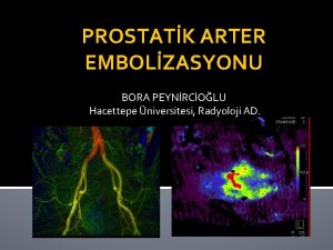 PROSTATK ARTER EMBOLZASYONU BORA PEYNRCOLU Hacettepe niversitesi Radyoloji