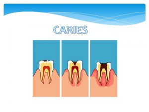 CARIES El termino caries proviene del latn que