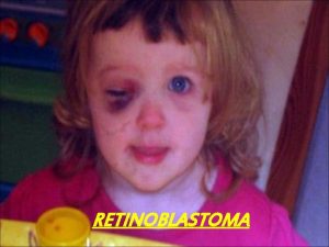 RETINOBLASTOMA PENGERTIAN v Retinoblastoma adalah tumor retina yang