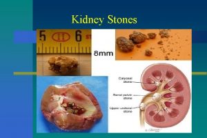 Kidney Stones Dr Usman Ghani Overview n Introduction