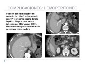 COMPLICACIONES HEMOPERITONEO Paciente con fallo heptico en contexto