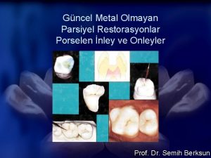 Gncel Metal Olmayan Parsiyel Restorasyonlar Porselen nley ve