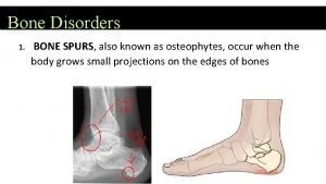 Bone Disorders 1 BONE SPURS also known as