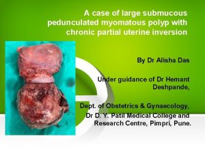 A case of large submucous pedunculated myomatous polyp