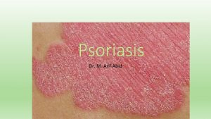 Psoriasis Dr M Arif Abid Psoriasis Description Inflammatory
