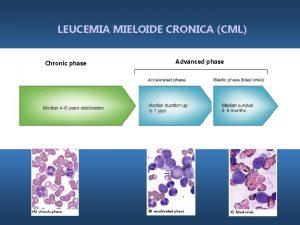 LEUCEMIA MIELOIDE CRONICA CML Chronic phase Advanced phase