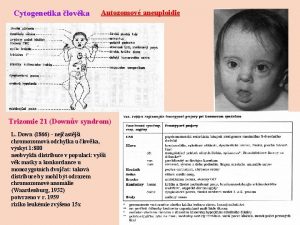 Cytogenetika lovka Autozomov aneuploidie Trizomie 21 Downv syndrom