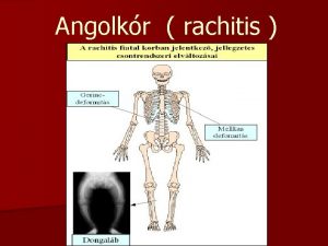 Angolkr rachitis n n Az angolkr vagy rachitis