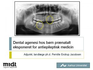 Dental agenesi hos brn prnatalt eksponeret for antiepileptisk