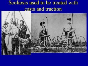 Scoliosis used to be treated with casts and