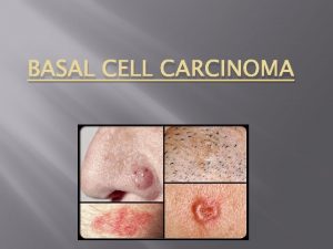BASAL CELL CARCINOMA What is it The Basal