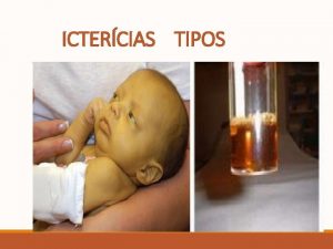 ICTERCIAS TIPOS ICTERCIA POR BILIRRUBINEMIA NO CONJUGADA OU