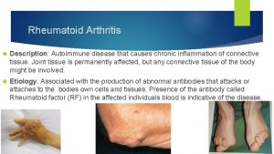 Rheumatoid Arthritis Description Autoimmune disease that causes chronic