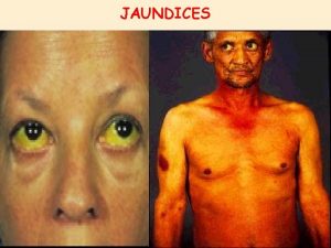 JAUNDICES What is Jaundice Jaundice is yellowish discoloration