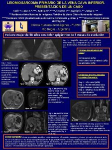 LEIOMIOSARCOMA PRIMARIO DE LA VENA CAVA INFERIOR PRESENTACION