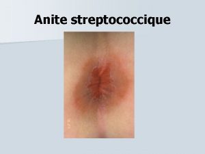 Anite streptococcique Affection frquente A lexamen clinique un