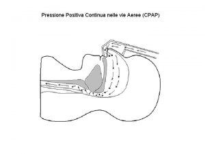 Pressione Positiva Continua nelle vie Aeree CPAP Pressione