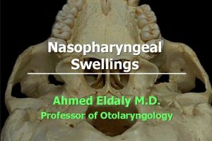 Nasopharyngeal Swellings Ahmed Eldaly M D Professor of