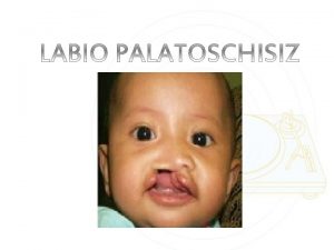 PENGERTIAN labio palatoschizis adalah suatu kelainan congenital berupa