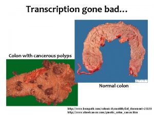 Transcription gone bad Colon with cancerous polyps Normal