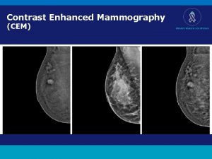 Contrast Enhanced Mammography CEM BREAST HEALTH SOLUTIONS Topics