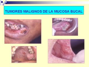 TUMORES MALIGNOS DE LA MUCOSA BUCAL Tumores Malignos