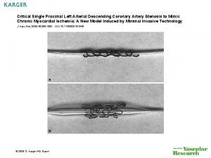 Critical Single Proximal Left Arterial Descending Coronary Artery