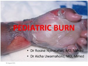 PEDIATRIC BURN Dr Rosine Nyirasafari MD Mmed Dr