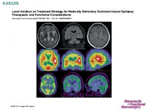 Laser Ablation as Treatment Strategy for Medically Refractory