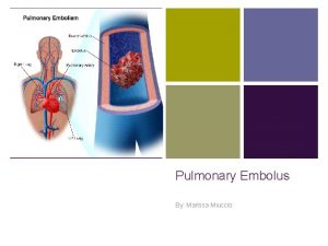 Pulmonary Embolus By Marissa Miuccio What is a