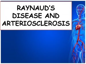 RAYNAUDS DISEASE AND ARTERIOSCLEROSIS RAYNAUDS DISEASE Affects the