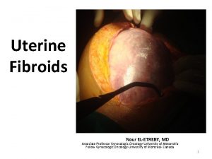 Uterine Fibroids Nour ELETREBY MD Associate Professor Gynecologic