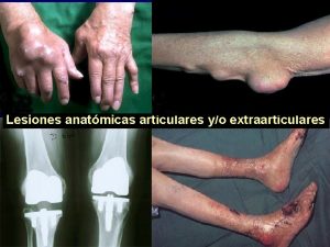 Lesiones anatmicas articulares yo extraarticulares Artritis reumatoide Concepto