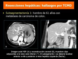 Resecciones hepticas hallazgos por TCMD Subsegmentectoma 1 hombre
