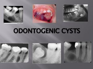 ODONTOGENIC CYSTS What are they Cysts are PATHOLOGICAL