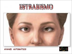 ESTRABISMO AVANCE AUTOMTICO Ojos normales El estrabismo es