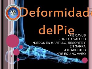 DEFORMIDADES DEL PIE PIE CAVUS HALLUX VALGUS DEDOS