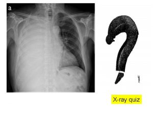 Xray quiz R pleural effusion pushing the mediastinum