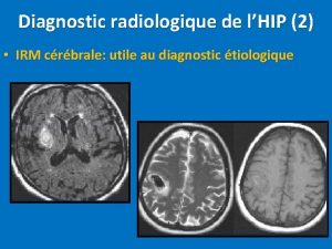 Diagnostic radiologique de lHIP 2 IRM crbrale utile