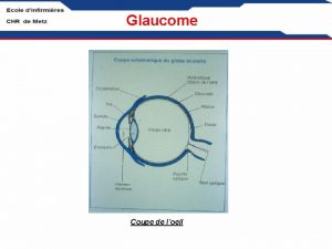 Glaucome Coupe de loeil Glaucome Circulation humeur aqueuse
